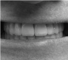 Mide en place de facettes dentaires